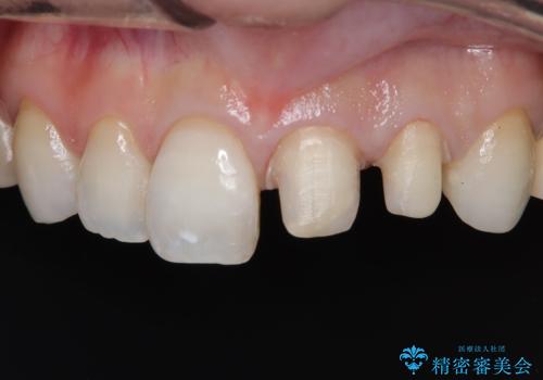 【オールセラミッククラウン】前歯の色が気になる! 左右で歯の長さが違うの治療中