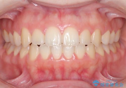 前歯のガタツキ、前歯の噛み合わせ(開咬)をインビザライン治療で治しましたの症例 治療後