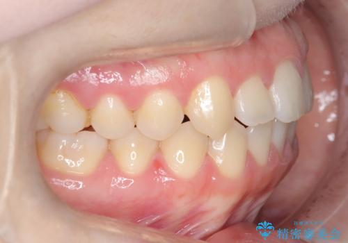 前歯のガタツキ、前歯の噛み合わせ(開咬)をインビザライン治療で治しましたの治療後