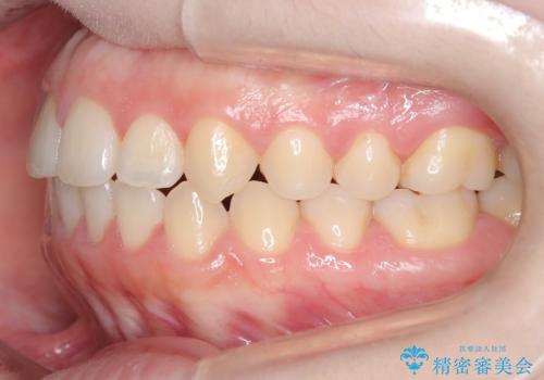 前歯のガタツキ、前歯の噛み合わせ(開咬)をインビザライン治療で治しましたの治療後