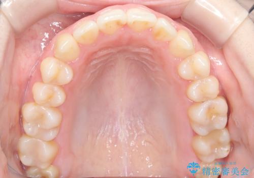 前歯のガタツキ、前歯の噛み合わせ(開咬)をインビザライン治療で治しましたの治療後