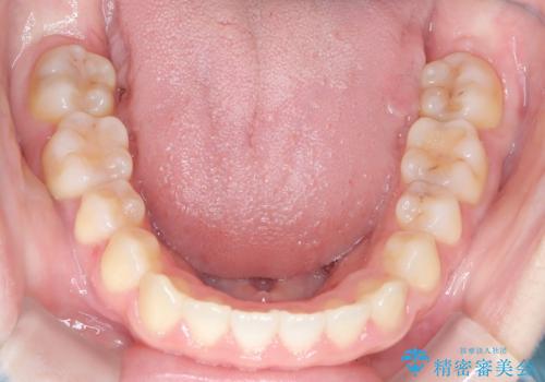 前歯のガタツキ、前歯の噛み合わせ(開咬)をインビザライン治療で治しましたの治療後