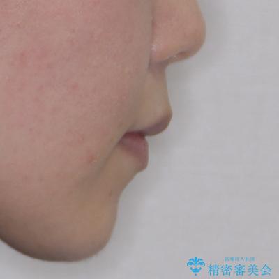 口が閉じにくい ワイヤー装置での抜歯矯正の治療後(顔貌)