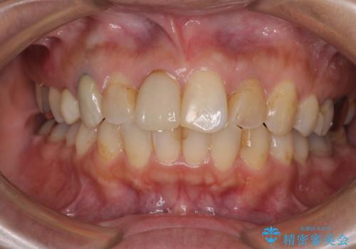 【モニター】処置歯の多い歯列　インビザラインでデコボコを整えるの治療中