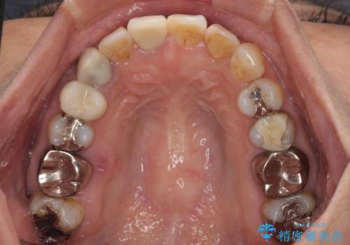 【モニター】処置歯の多い歯列　インビザラインでデコボコを整えるの治療中
