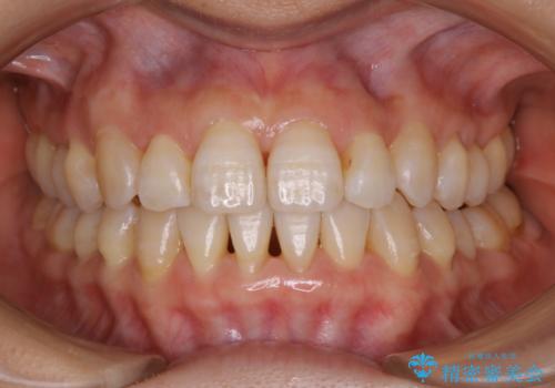 インビザライン、非抜歯でここまでできる。補助装置との組み合わせで顎のゆがみとかみ合わせを治すの治療後