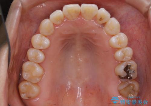 インビザライン、非抜歯でここまでできる。補助装置との組み合わせで顎のゆがみとかみ合わせを治すの治療後