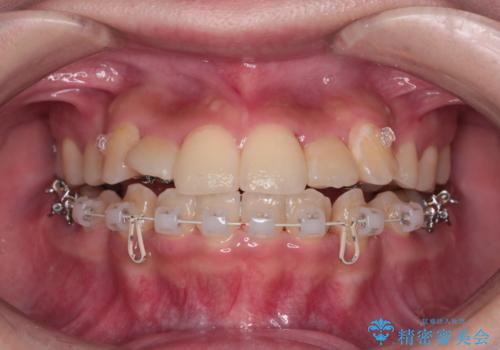 【ハーフリンガル】重度の叢生の治療中