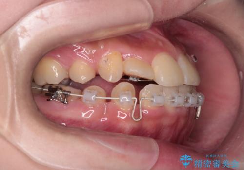 【ハーフリンガル】重度の叢生の治療中