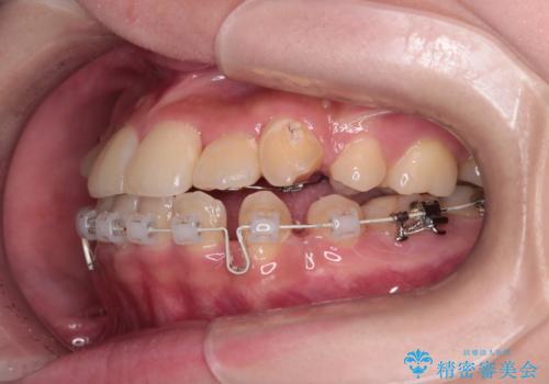 【ハーフリンガル】重度の叢生の治療中