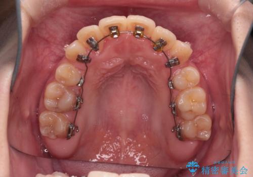 【ハーフリンガル】重度の叢生の治療中