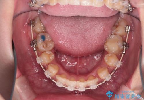 【ハーフリンガル】重度の叢生の治療中