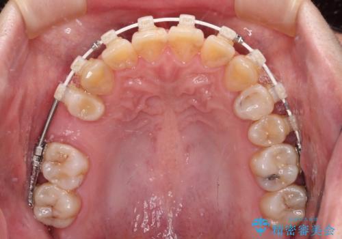 むし歯と咬み合わせで奥歯に負担がかかる　総合歯科治療で悩みを改善の治療中
