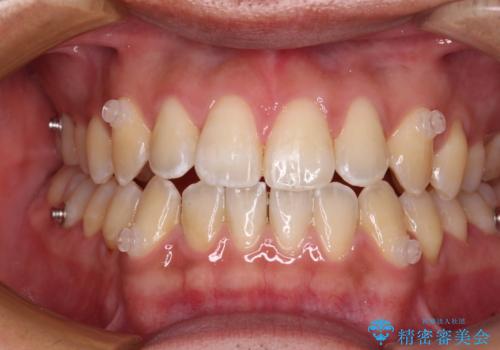 ワイヤー矯正を併用したインビザライン矯正治療の治療中