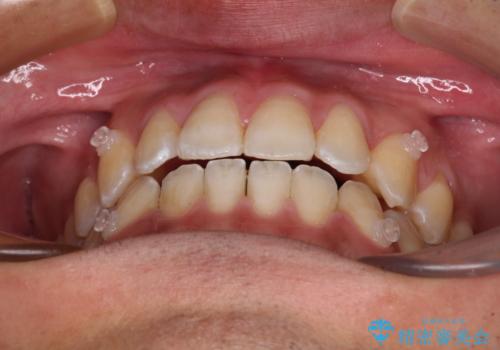 ワイヤー矯正を併用したインビザライン矯正治療の治療中