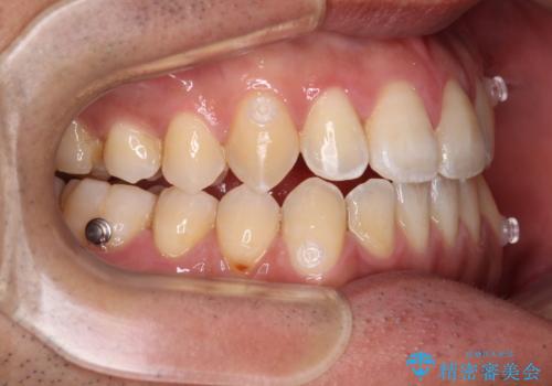 ワイヤー矯正を併用したインビザライン矯正治療の治療中