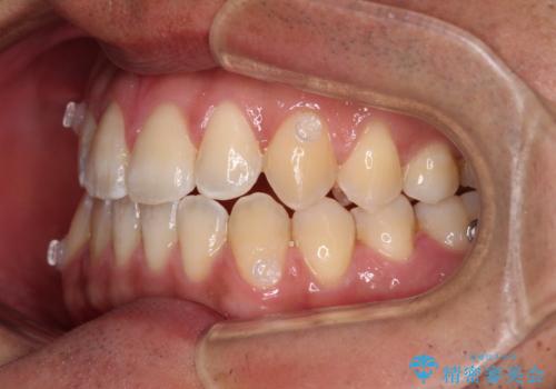 ワイヤー矯正を併用したインビザライン矯正治療の治療中