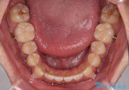 ワイヤー矯正を併用したインビザライン矯正治療の治療中