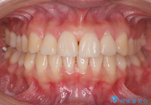 前歯がねじれている 奥歯を後ろに下げて歯を抜かずに並べましたの治療後