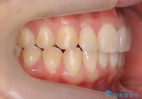 前歯がねじれている 奥歯を後ろに下げて歯を抜かずに並べましたの治療後