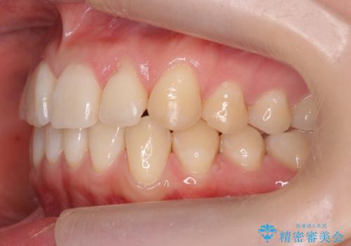 前歯がねじれている 奥歯を後ろに下げて歯を抜かずに並べましたの治療後