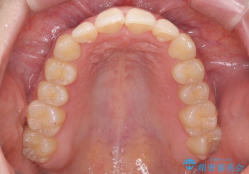 前歯がねじれている 奥歯を後ろに下げて歯を抜かずに並べましたの治療後