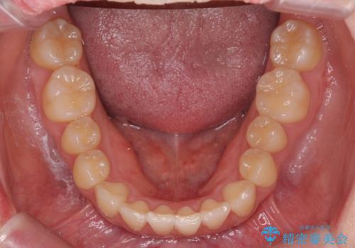 前歯がねじれている 奥歯を後ろに下げて歯を抜かずに並べましたの治療後