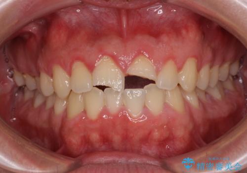 酔っ払ってぶつけた前歯 オールセラミッククラウンで自然な前歯にの治療前