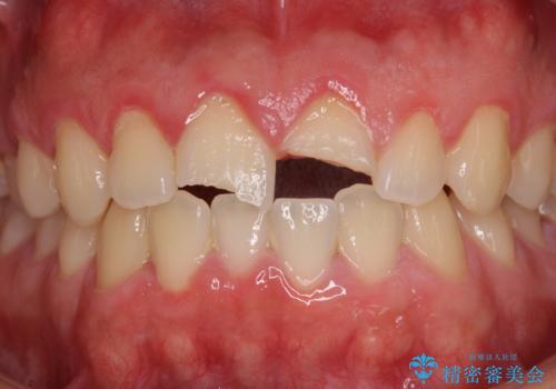 酔っ払ってぶつけた前歯 オールセラミッククラウンで自然な前歯にの治療前