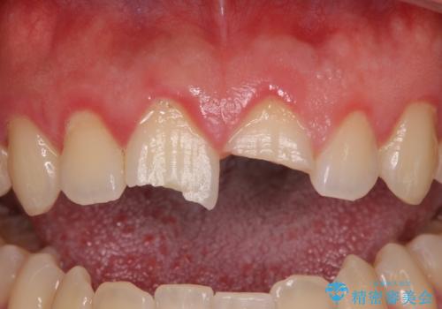 酔っ払ってぶつけた前歯 オールセラミッククラウンで自然な前歯にの治療前
