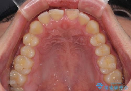 酔っ払ってぶつけた前歯 オールセラミッククラウンで自然な前歯にの治療前