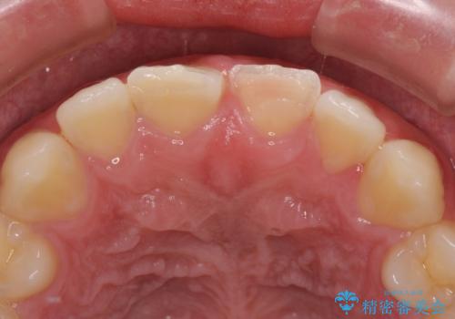 酔っ払ってぶつけた前歯 オールセラミッククラウンで自然な前歯にの治療前