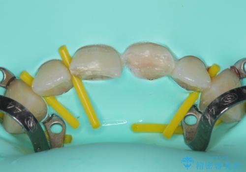 酔っ払ってぶつけた前歯 オールセラミッククラウンで自然な前歯にの治療中