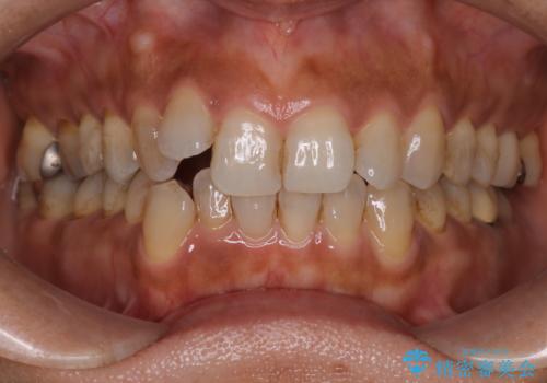 インビザラインで自然な美しさへ、前歯のガタツキを改善しましたの症例 治療前