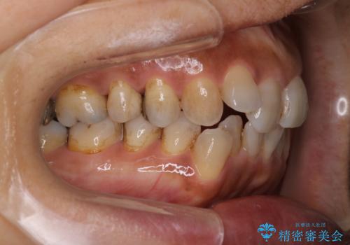 インビザラインで自然な美しさへ、前歯のガタツキを改善しましたの治療前