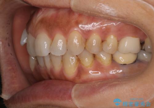 インビザラインで自然な美しさへ、前歯のガタツキを改善しましたの治療前