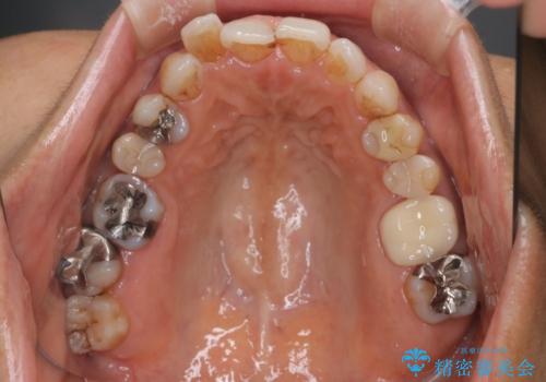 インビザラインで自然な美しさへ、前歯のガタツキを改善しましたの治療前