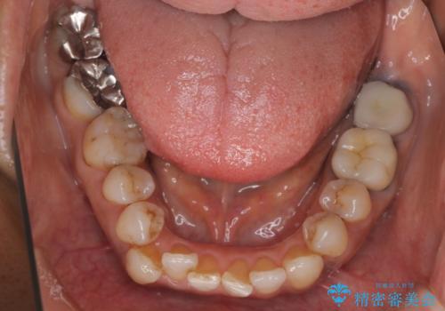 インビザラインで自然な美しさへ、前歯のガタツキを改善しましたの治療前