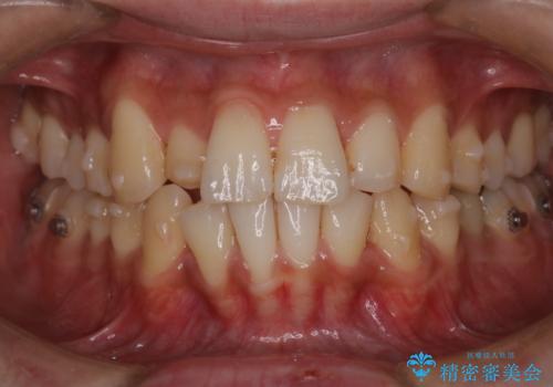 【インビザライン】マウスピース矯正希望。の治療中