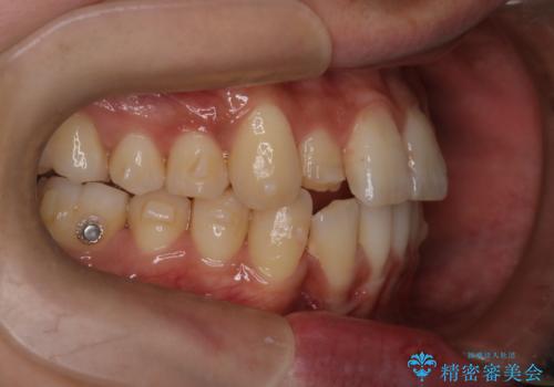 【インビザライン】マウスピース矯正希望。の治療中