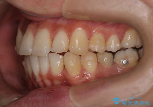 【インビザライン】マウスピース矯正希望。の治療中