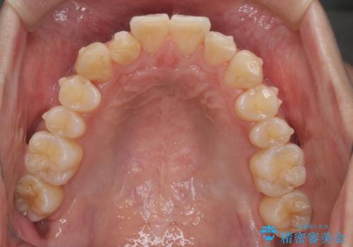 【インビザライン】マウスピース矯正希望。の治療中