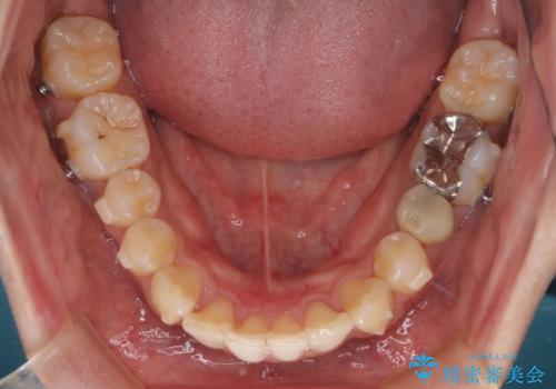 【インビザライン】マウスピース矯正希望。の治療中