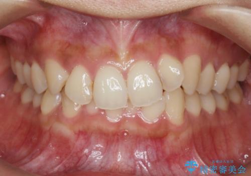 ワイヤー部分矯正治療を併用したマウスピース矯正治療の症例 治療前