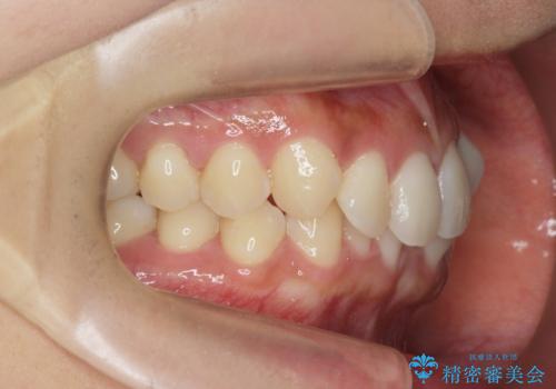 ワイヤー部分矯正治療を併用したマウスピース矯正治療の治療前