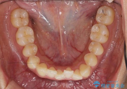 ワイヤー部分矯正治療を併用したマウスピース矯正治療の治療前