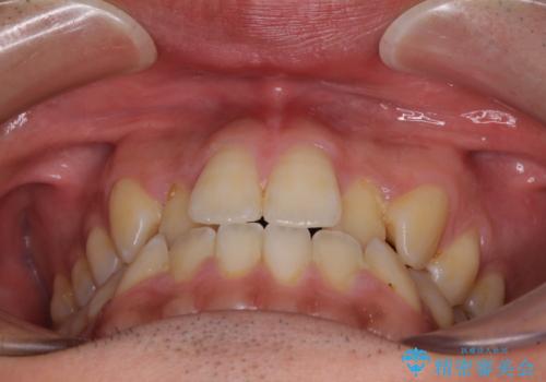 ワイヤー矯正を併用したインビザライン矯正治療の治療前