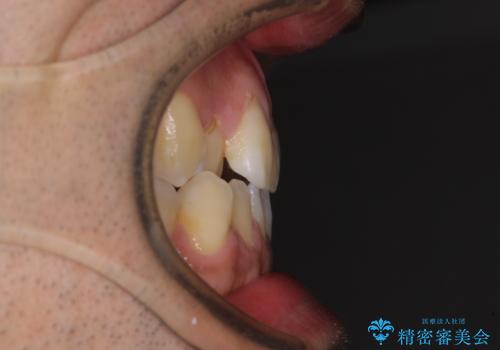 ワイヤー矯正を併用したインビザライン矯正治療の治療前