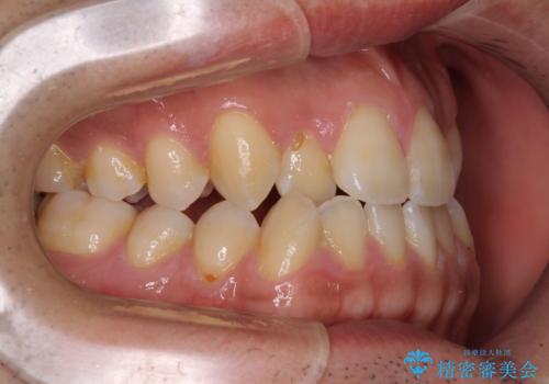 ワイヤー矯正を併用したインビザライン矯正治療の治療前