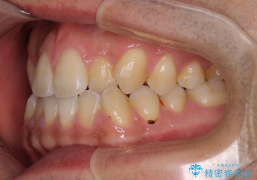 ワイヤー矯正を併用したインビザライン矯正治療の治療前